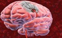 Ցողունային բջիջները կօգնեն վերականգնել ուղեղն ինսուլտից հետո